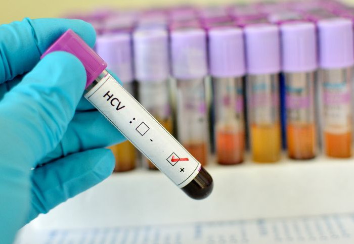 Concorso-di-cause-naturali-e-condotta umana-HCV