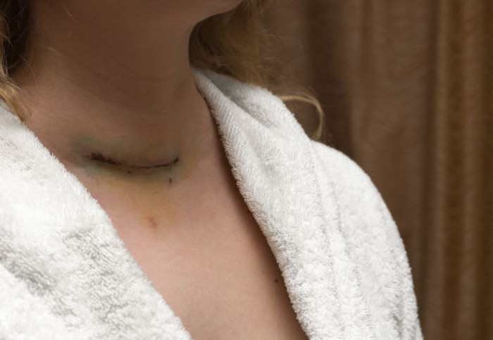 Tiroidectomia-calcolo-del-risarcimento