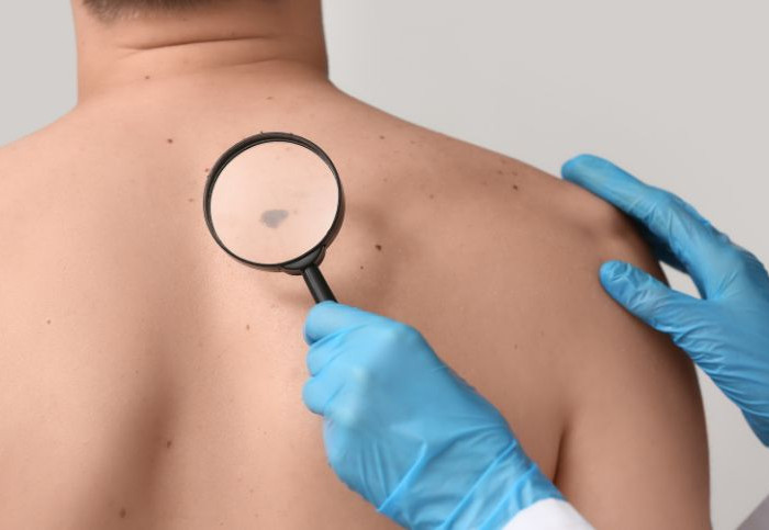 diagnosi-tardiva-melanoma