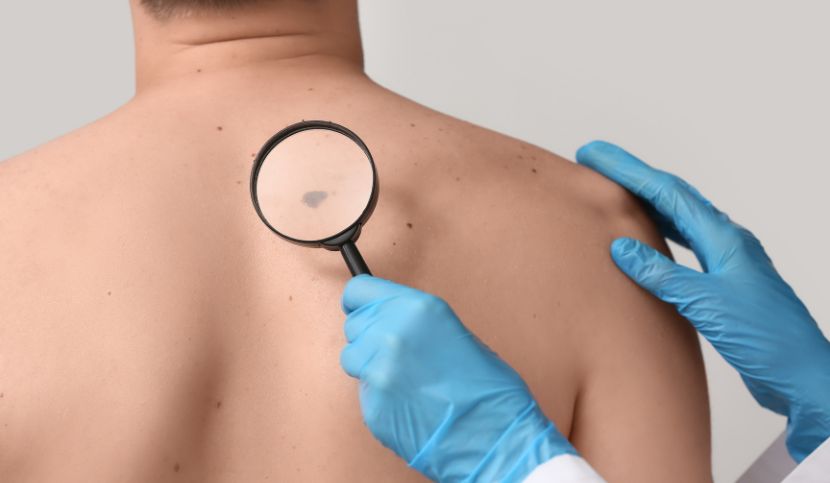 diagnosi-tardiva-melanoma